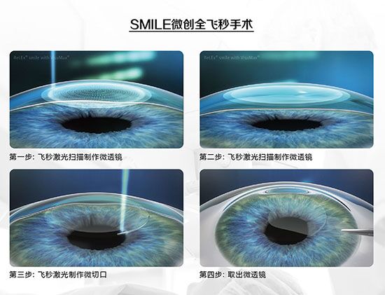 蔡司全飛秒、蔡司半飛秒近視手術與宇航飛秒的區(qū)別